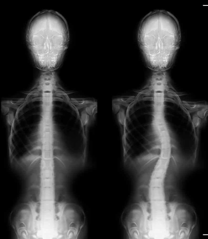 The Best Scoliosis Therapy & Treatment