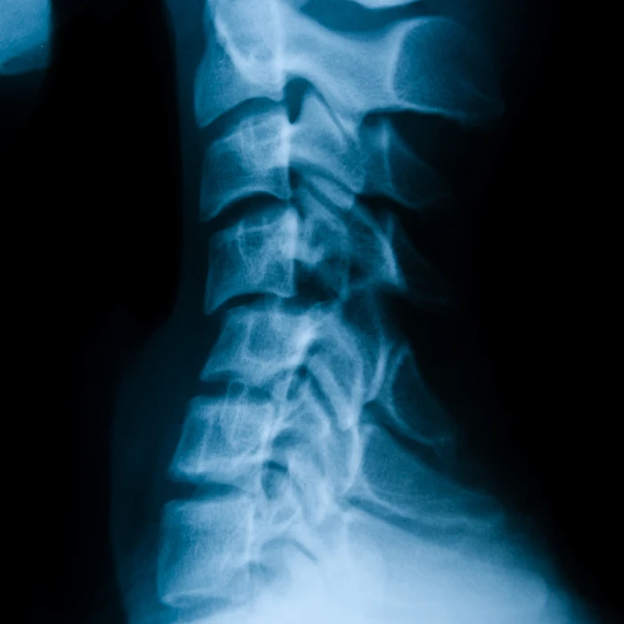 Precision Subluxation Therapy & Treatment